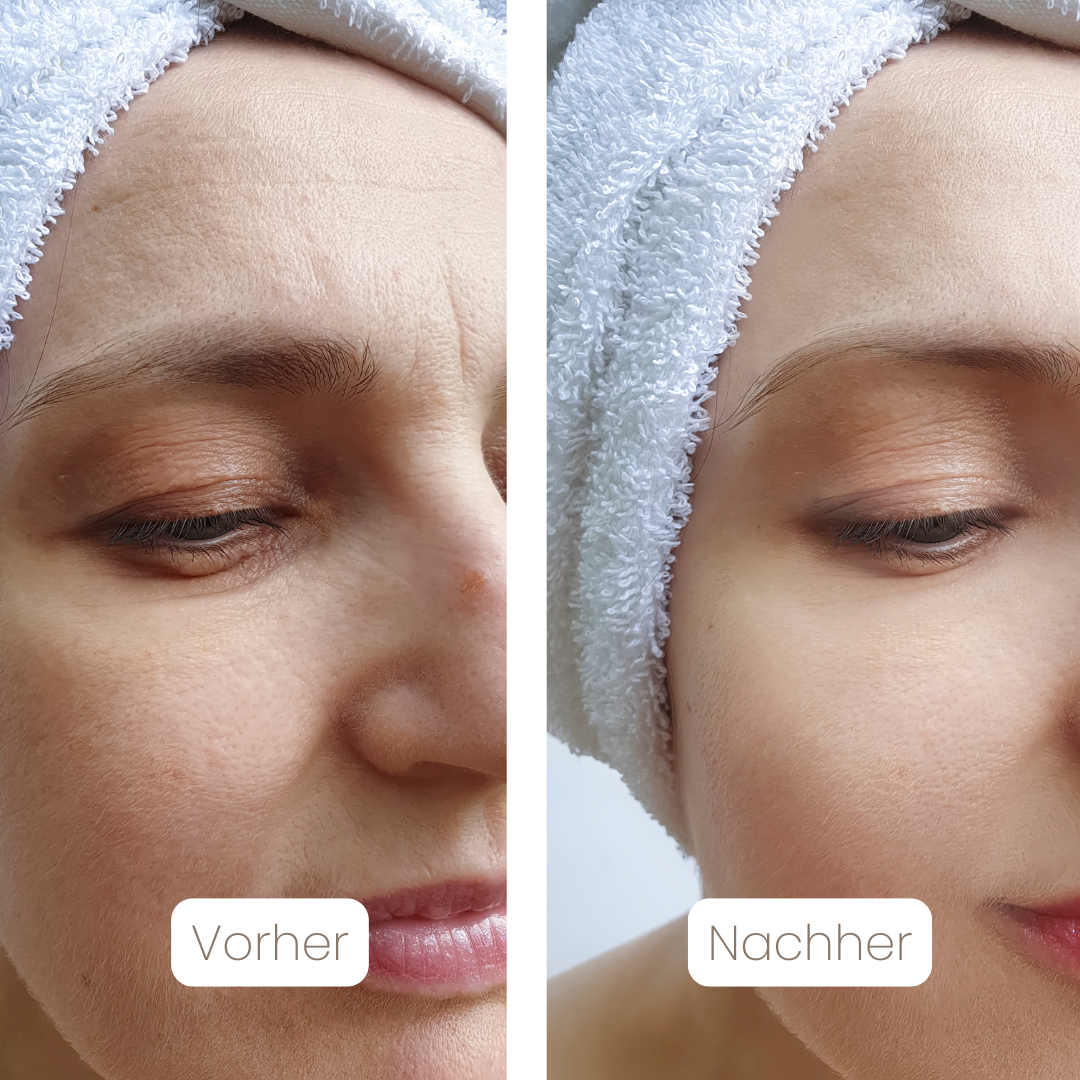 DermaSil™ — Silikon Narbenpflege-Stick