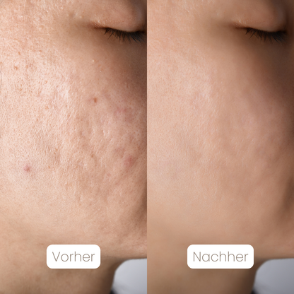 DermaSil™ — Silikon Narbenpflege-Stick