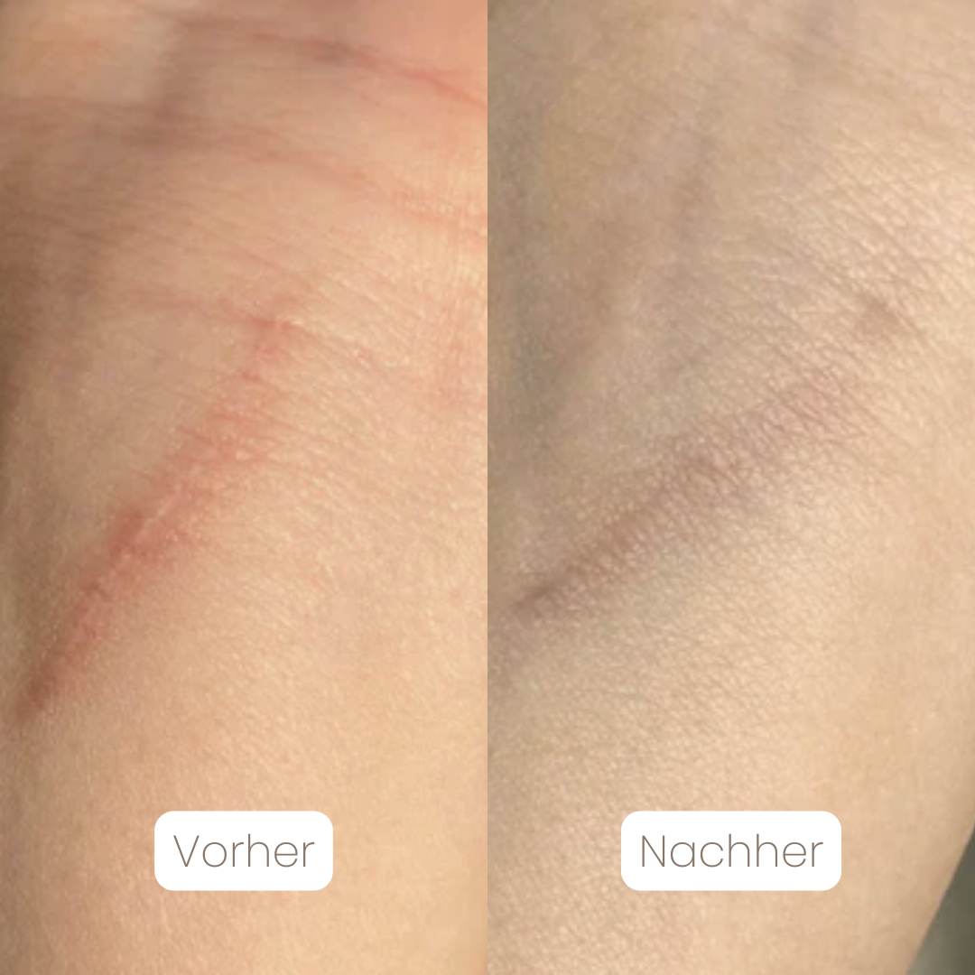 DermaSil™ — Silikon Narbenpflege-Stick